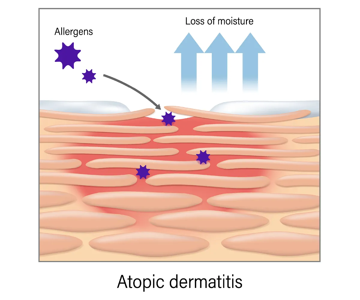 Image shows how the loss of moisture with atopic dermatitis, or eczema, allows allergens to enter the skin creating a rash. 