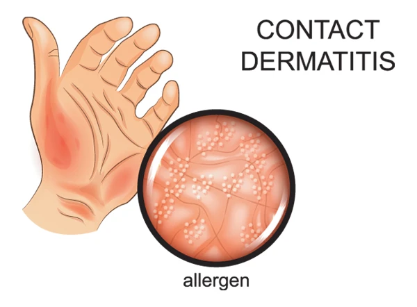Image shows a hand with contact dermatitis that is irritated with redness and inflammation from allergens. 