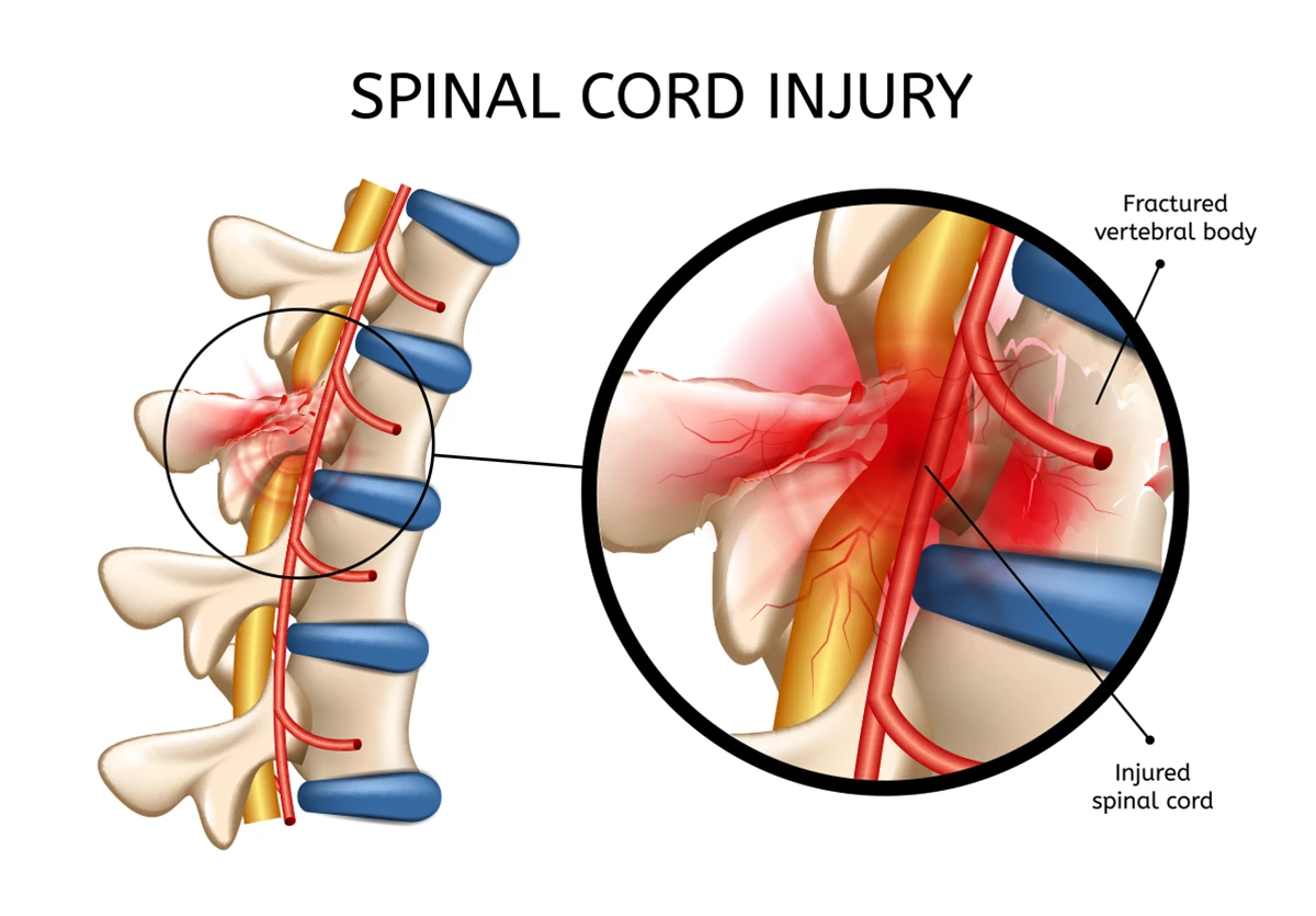 The image shows an injury to the spinal cord and a fractured vertebra on part of the spine.