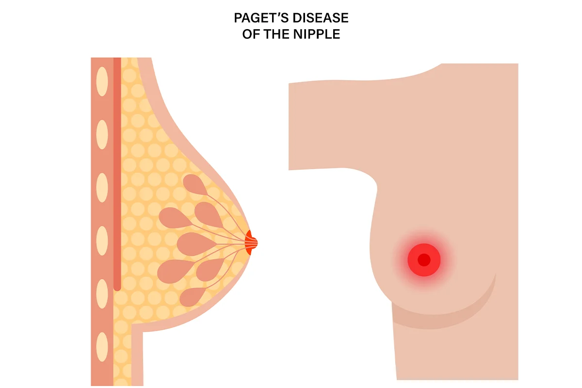 The image shows the nipple of the breast inflamed due to Paget’s disease of the breast.
