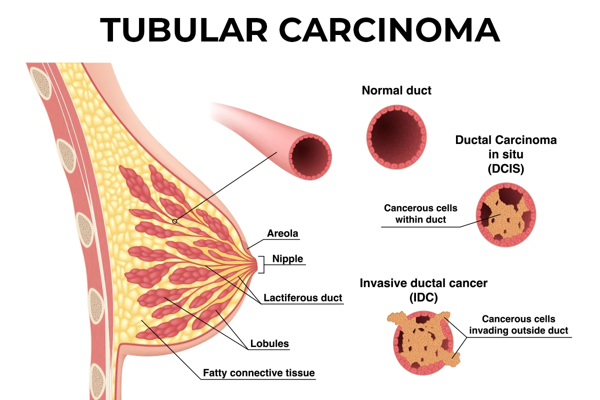 The image shows the anatomy of the breast, a normal milk duct in the breast, a milk duct with ductal carcinoma in situ and a milk duct with invasive ductal carcinoma.