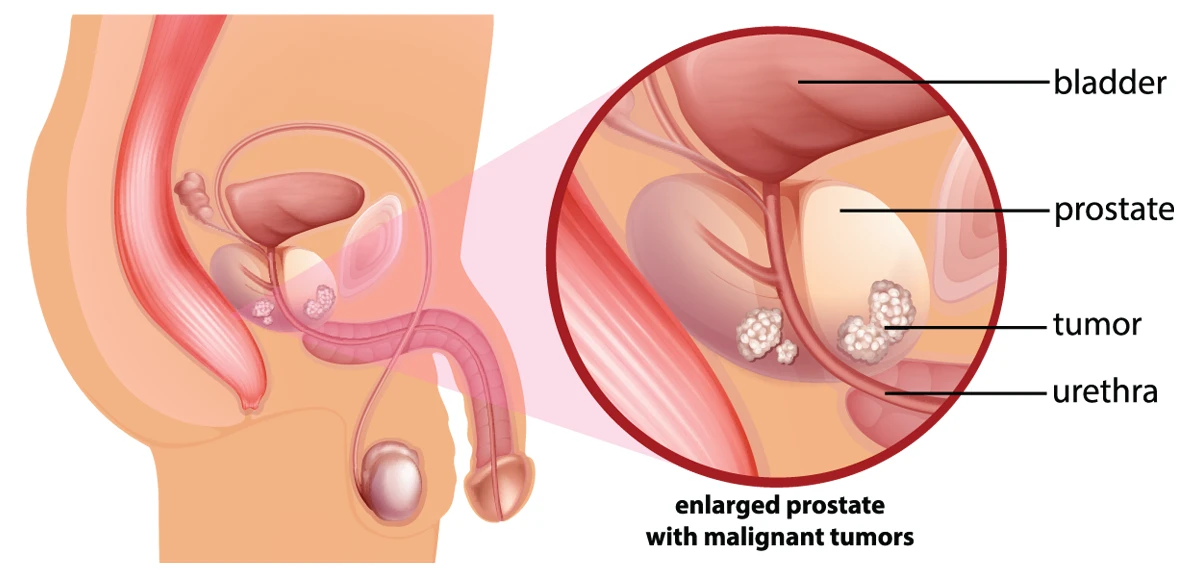 prostate-cancer