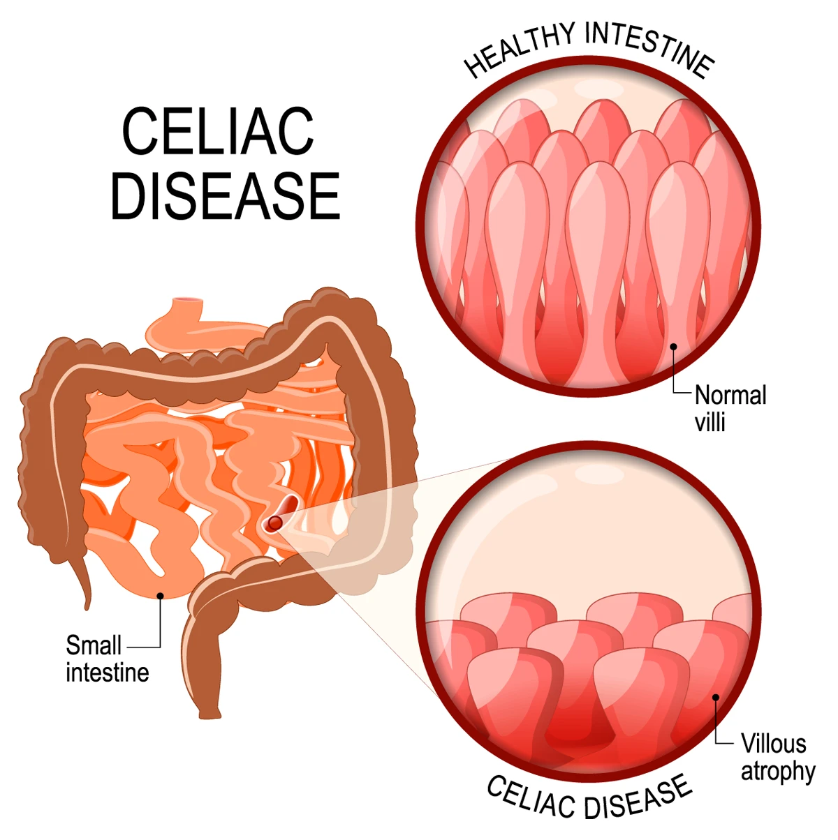 Images show healthy intestinal lining and damage to the intestinal lining caused by celiac disease.