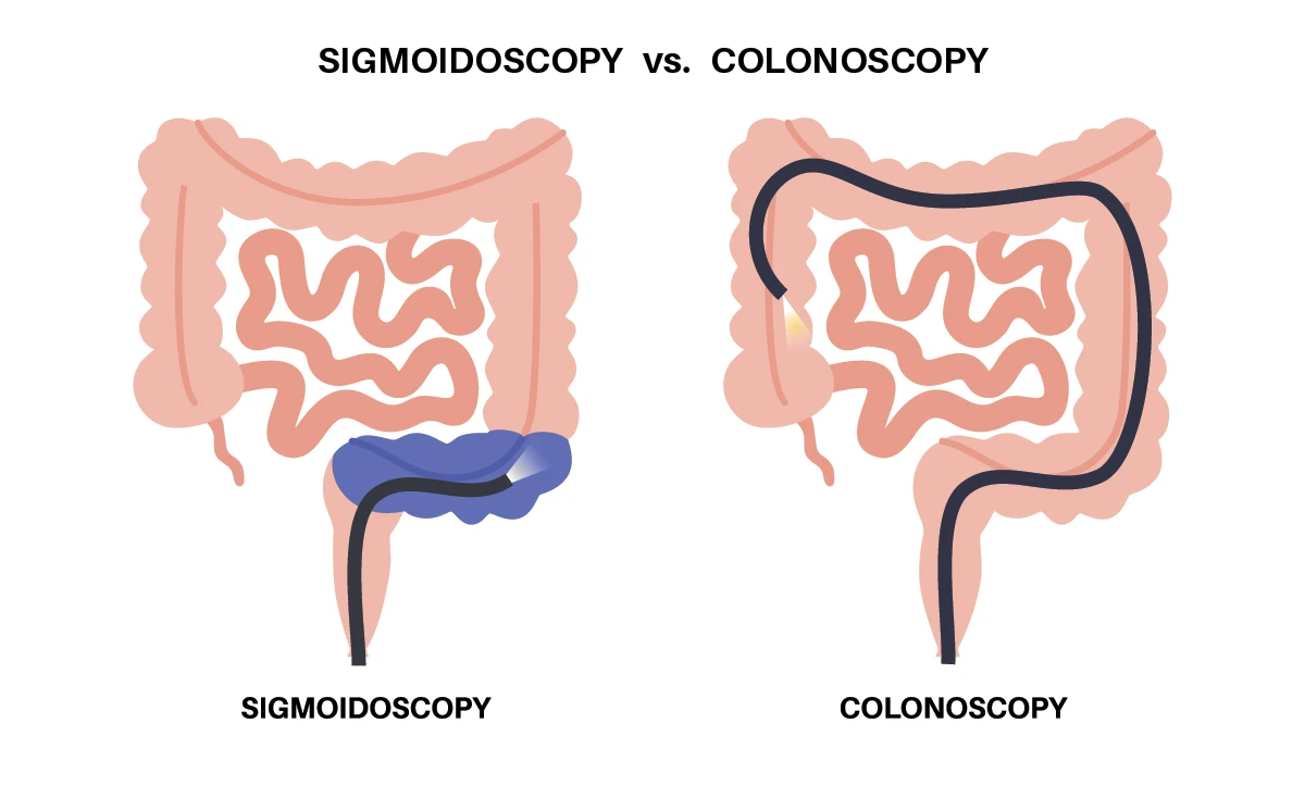 Flexible Sigmoidoscopy