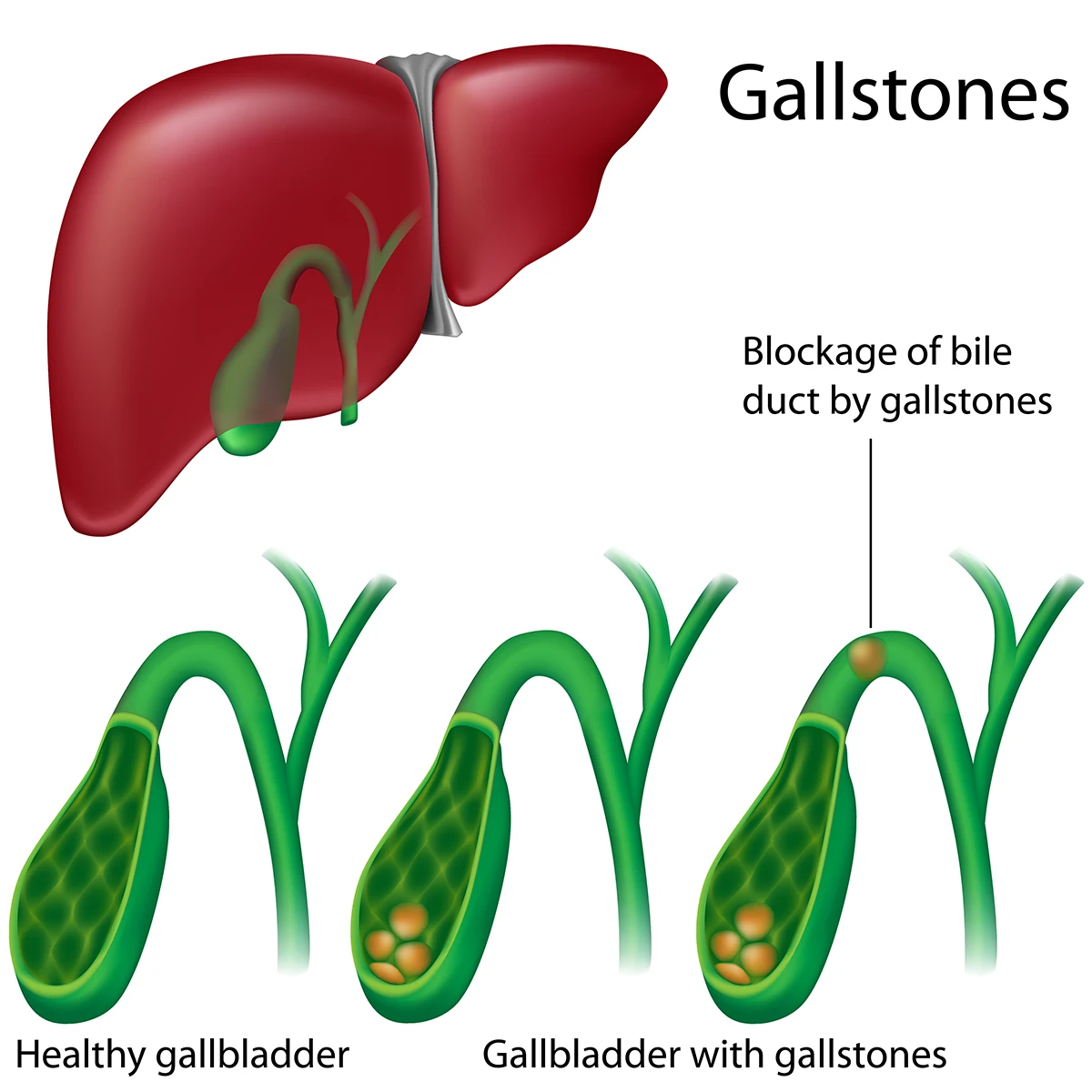 Rendering of Gallstones