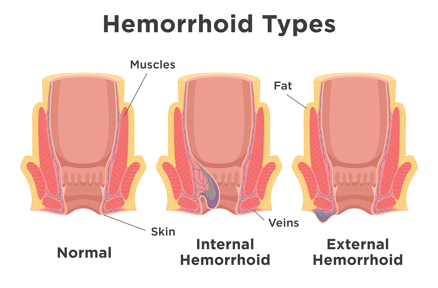An illustration of three rectums shows what a rectal opening looks like with no hemorrhoids, with an internal hemorrhoid and with an external hemorrhoid. 