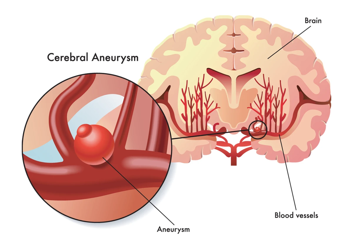 The image shows a blood vessel with an unruptured brain aneurysm.