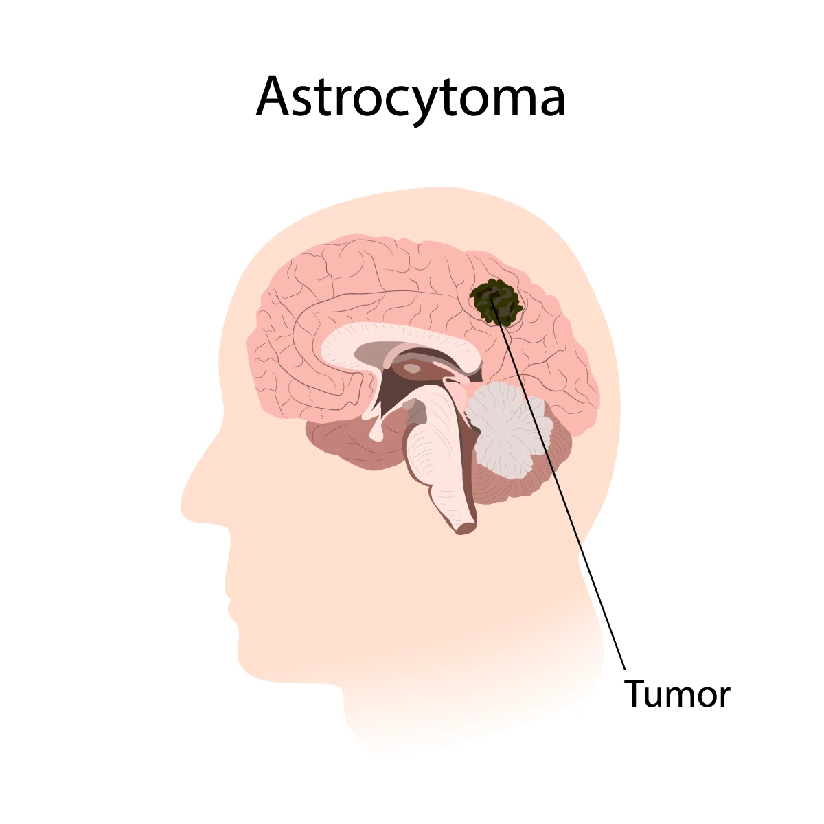 Image shows astrocytoma tumor in the brain.