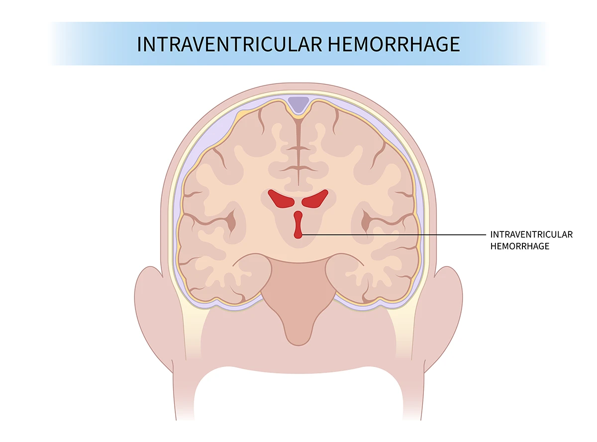 Image shows the location and size of an intraventricular hemorrhage in the brain