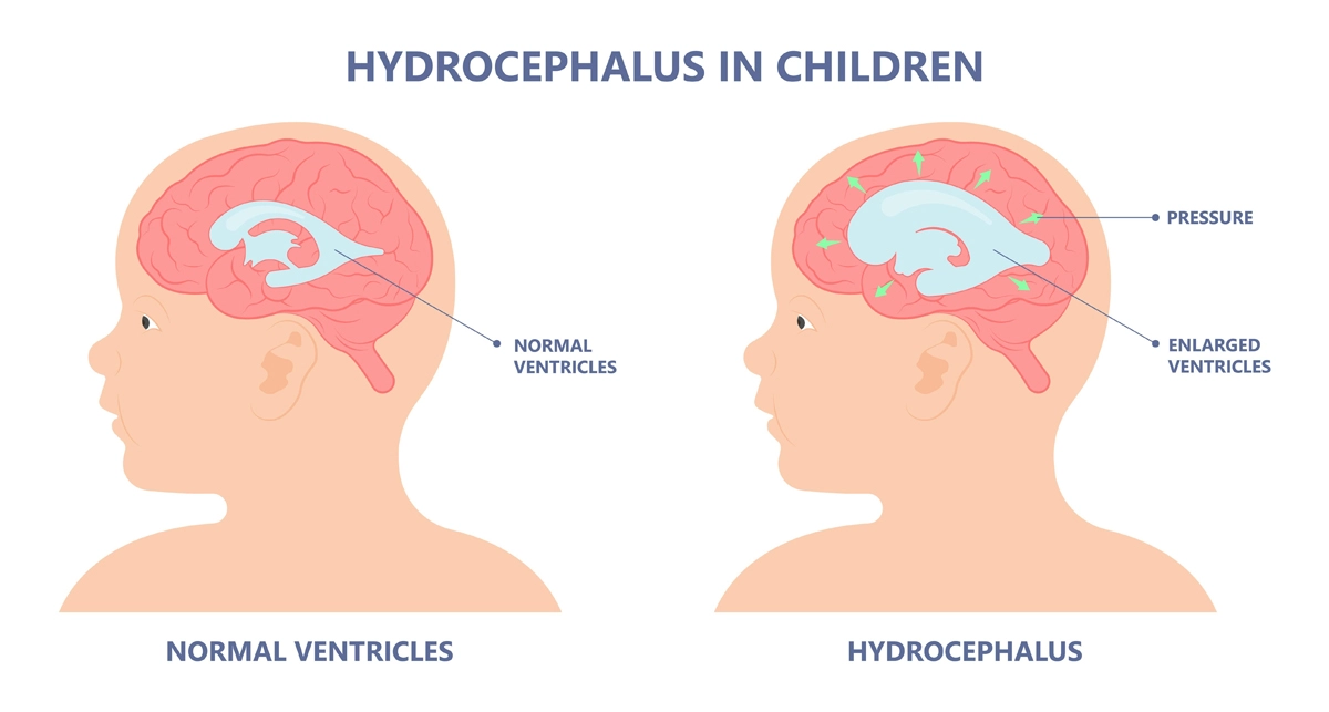 Image shows hydrocephalus in a baby that causes the accumulation of cerebrospinal fluid in the brain, leading to enlarged ventricles and increased pressure in the head.