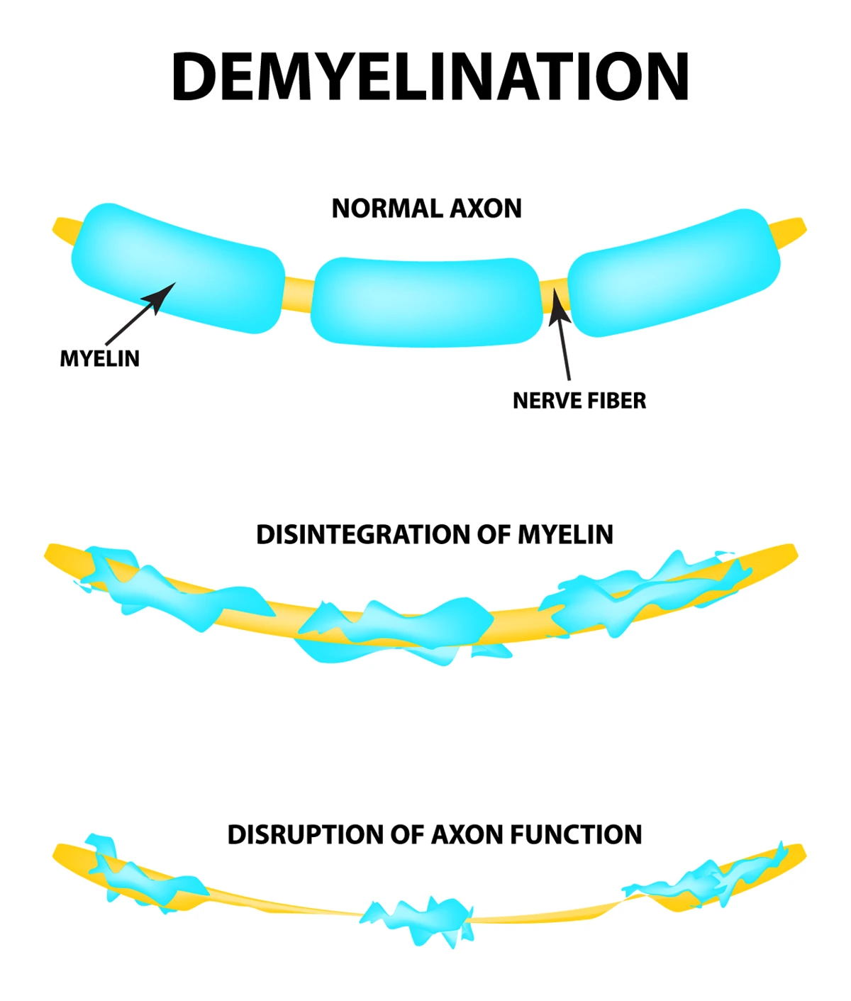 Image shows the process of demyelination and the loss of myelin from a type of demyelination disease