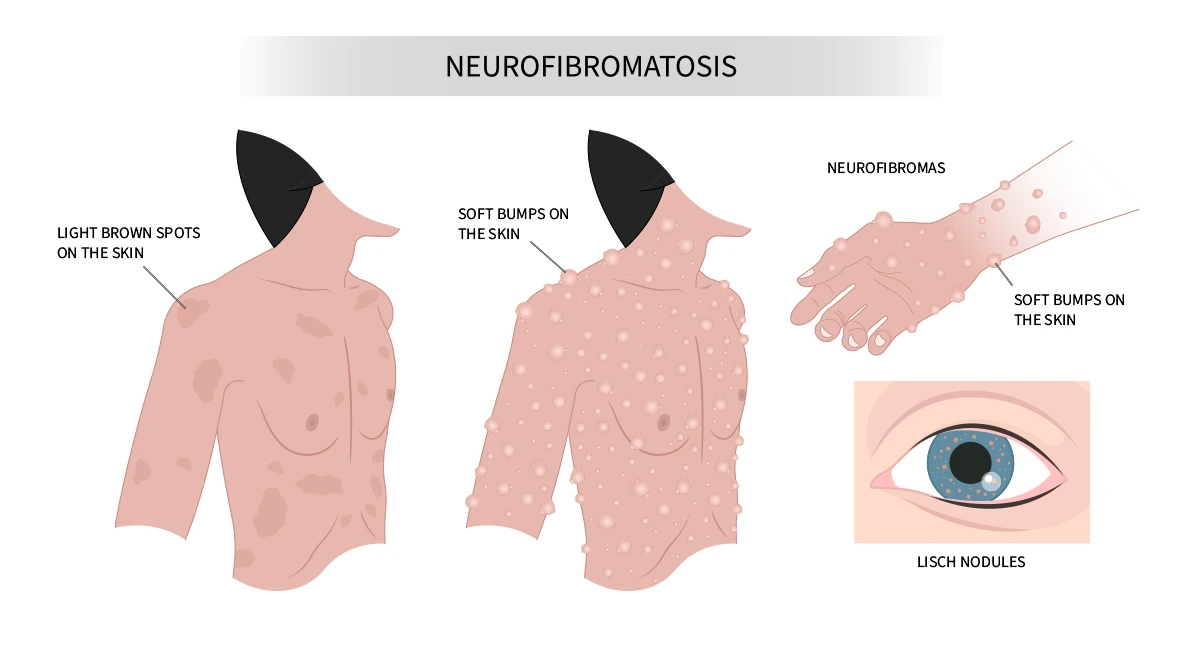 This image shows common symptoms of neurofibromatosis type 1 – café au lait spots, neurofibromas and Lisch nodules in the eyes