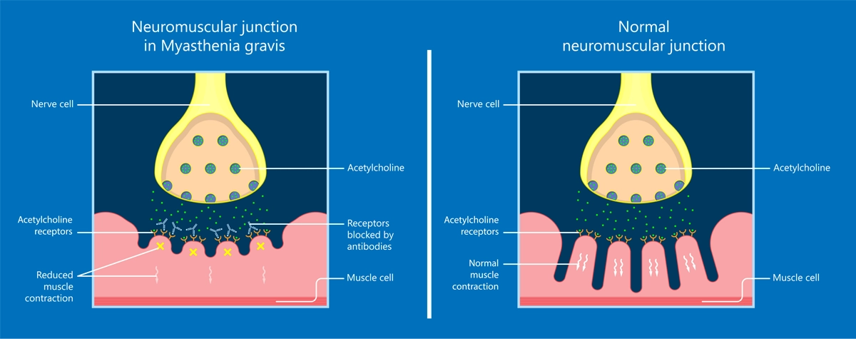 Image shows the difference between how messages from nerves transfer to muscles normally and when affected by myasthenia gravis.