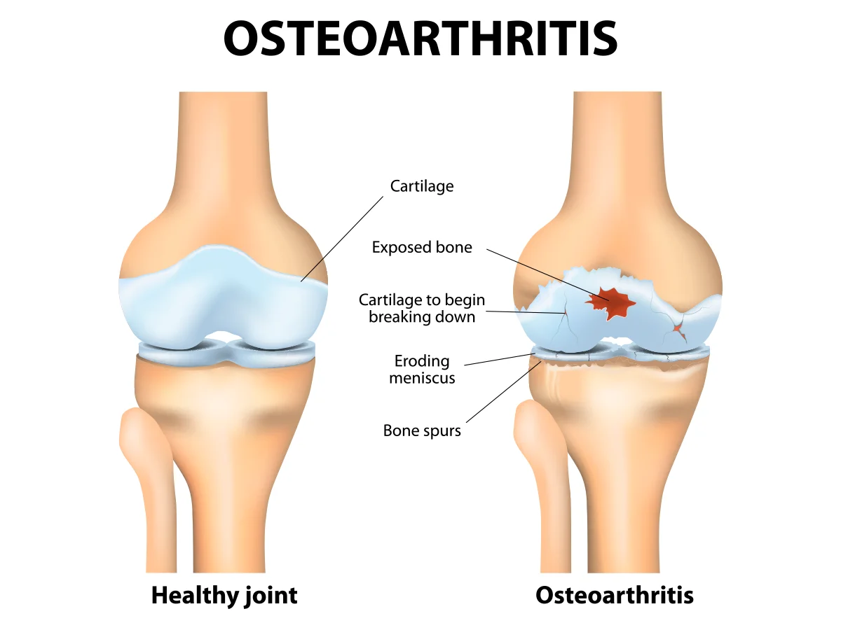 osteoarthritis