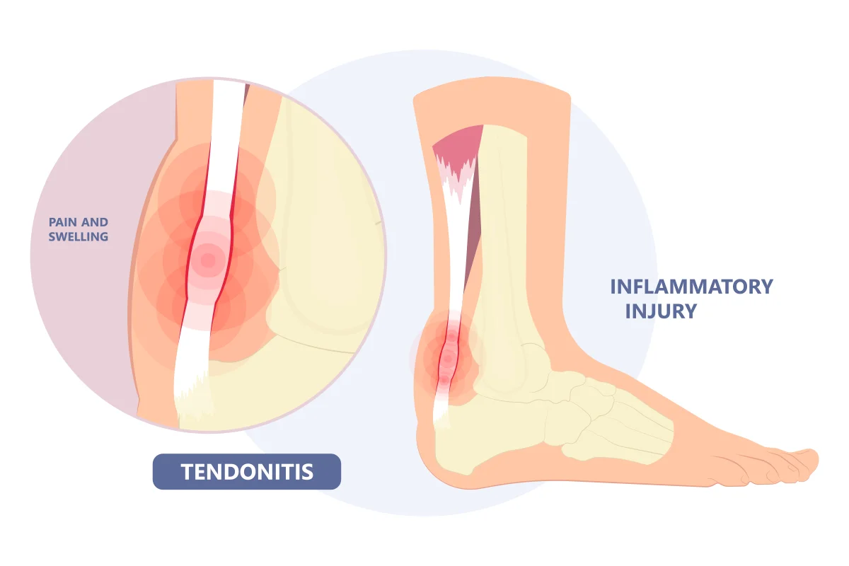 tendonitis