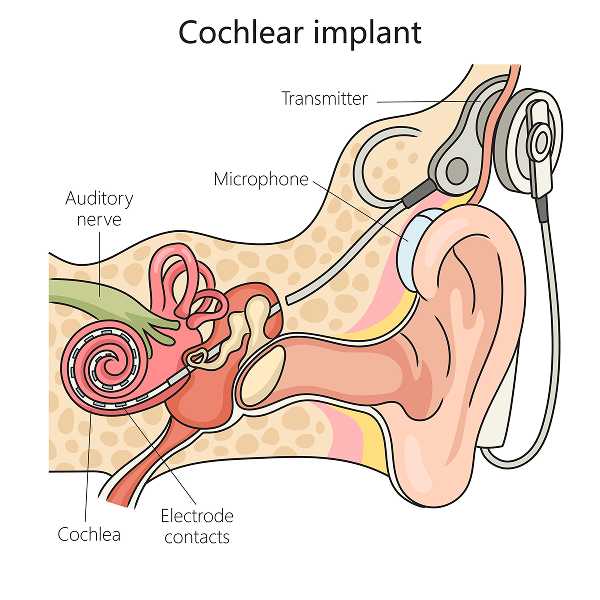 Image shows the parts of a cochlear implant and their placement, including the transmitter, microphone, and electrode contacts.