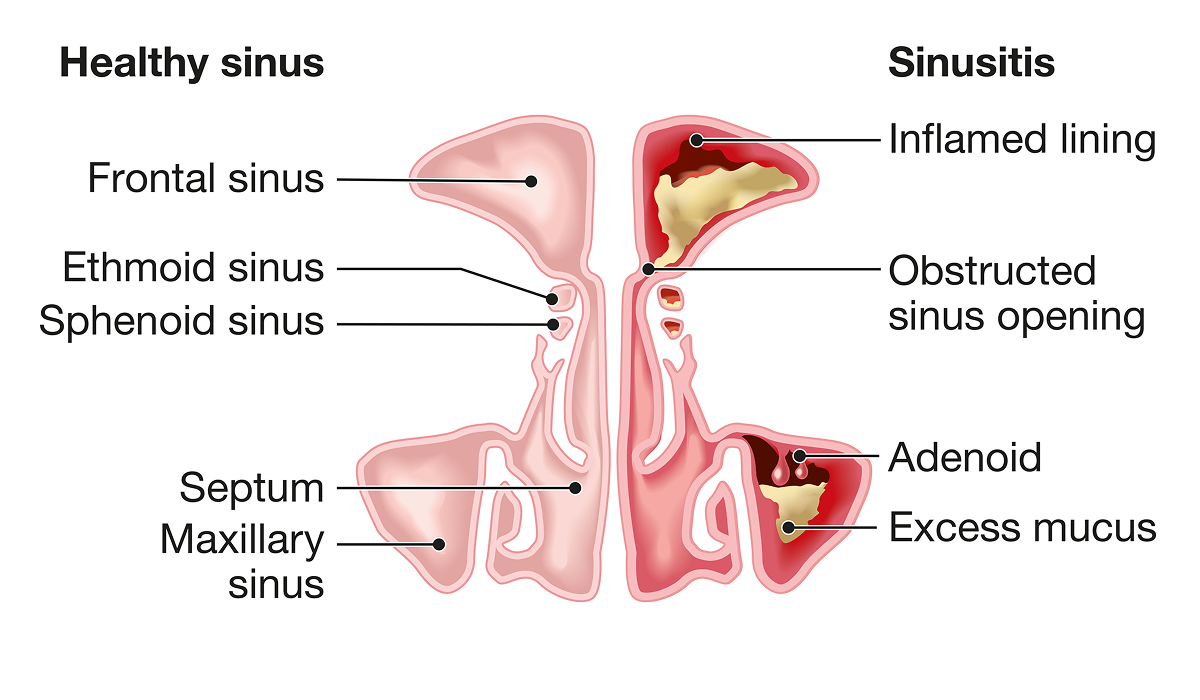 This diagram shows a side-by-side comparison of healthy sinus and sinus with sinusitis. The healthy side has open, clear sinuses, while the sinusitis side has inflamed sinus lining, obstructed sinus openings, excess mucus and swollen adenoids. Labels identify the frontal, ethmoid, sphenoid and maxillary sinuses, and the septum.