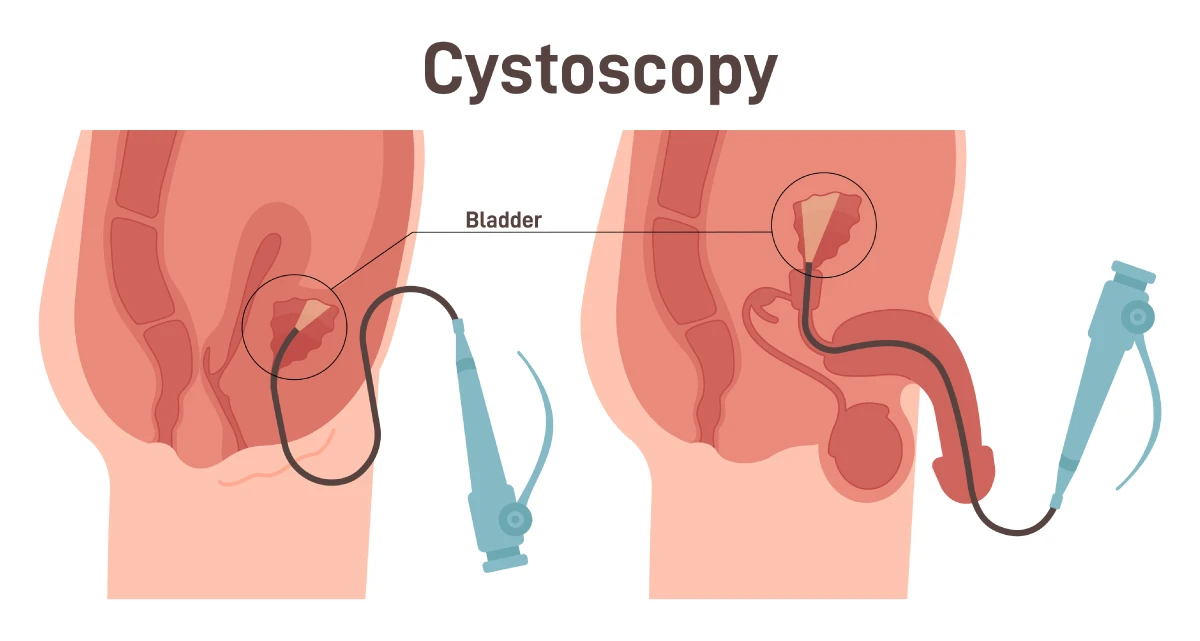 Cystoscopy diagram