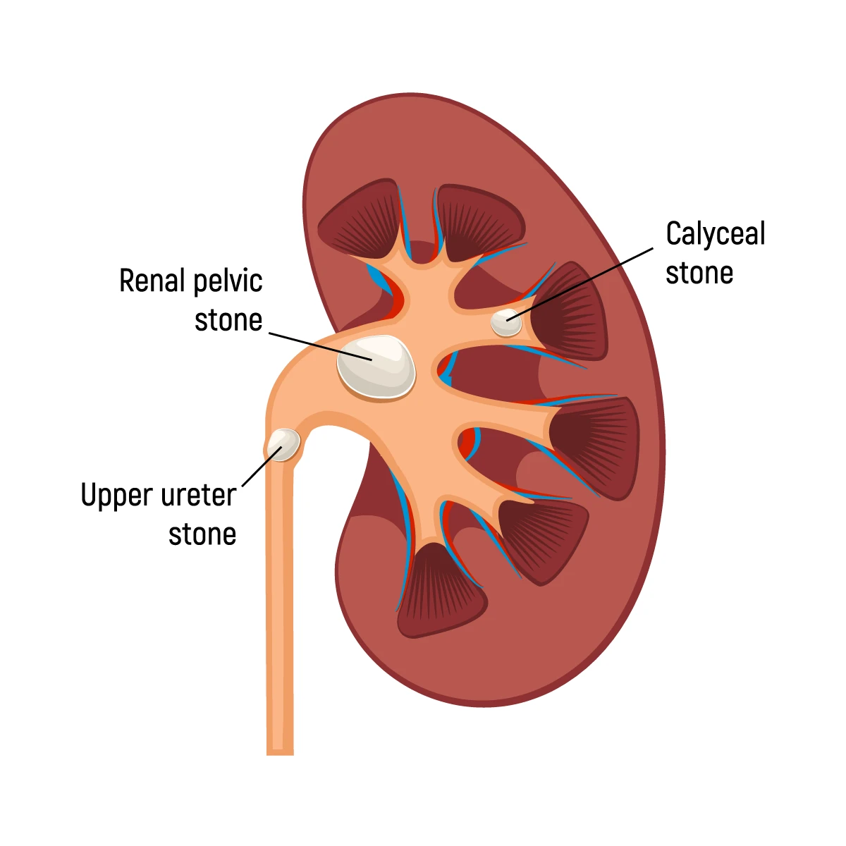 Rendering of ureteral stones