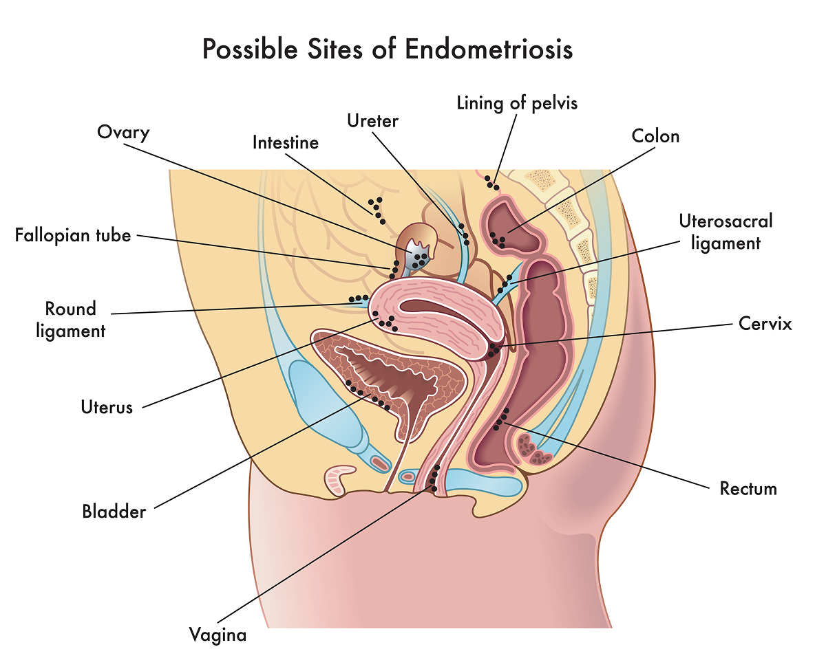 The image of endometriosis sites shows where they may develop, including the vagina, bladder, uterus, round ligament, fallopian tube, ovary, intestine, ureter, lining of pelvis, colon, uterosacral ligament, cervix or rectum.