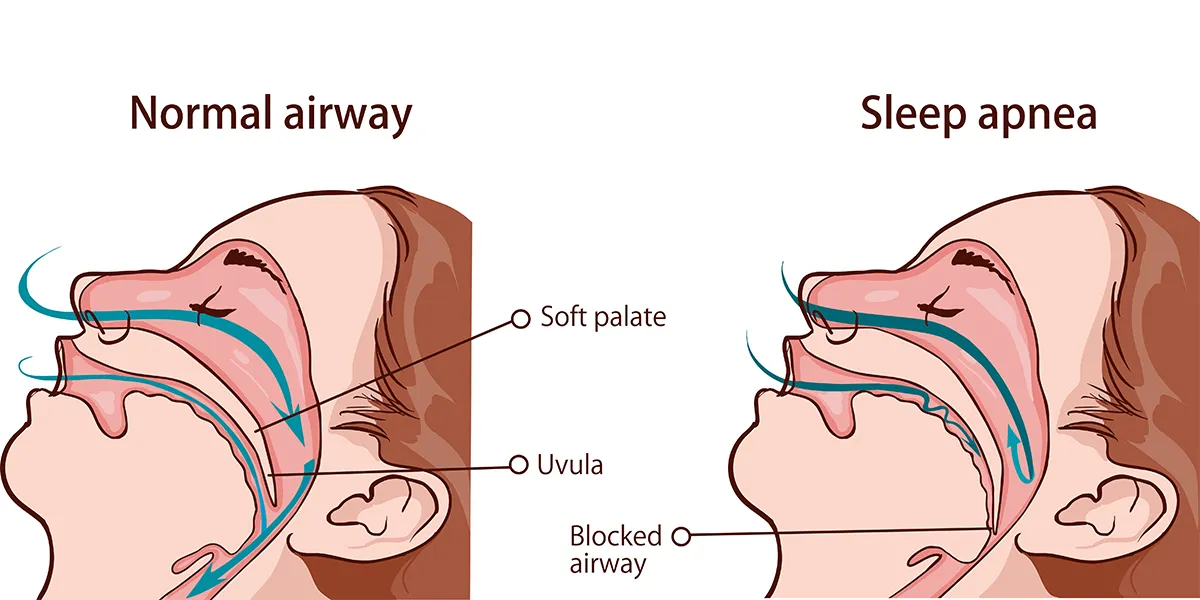 Illustration compares a normal airway with an airway affected by sleep apnea. The image shows how the soft palate and uvula block the airway in obstructive sleep apnea, leading to breathing difficulties.